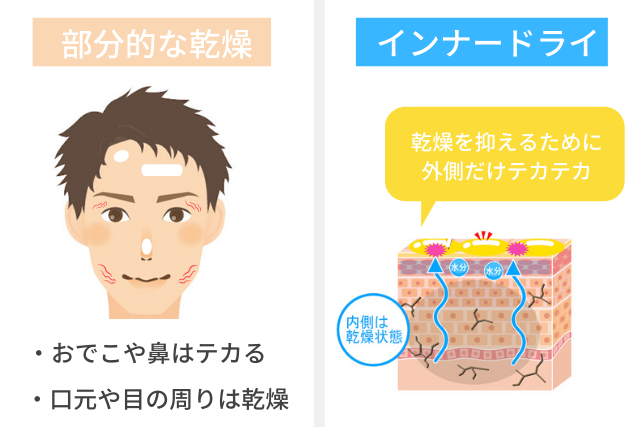 混合肌とインナードライ