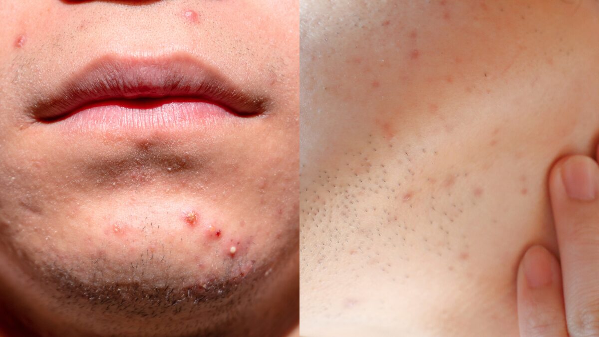 髭剃りによる剃刀負け